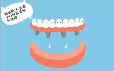半口牙齿种植